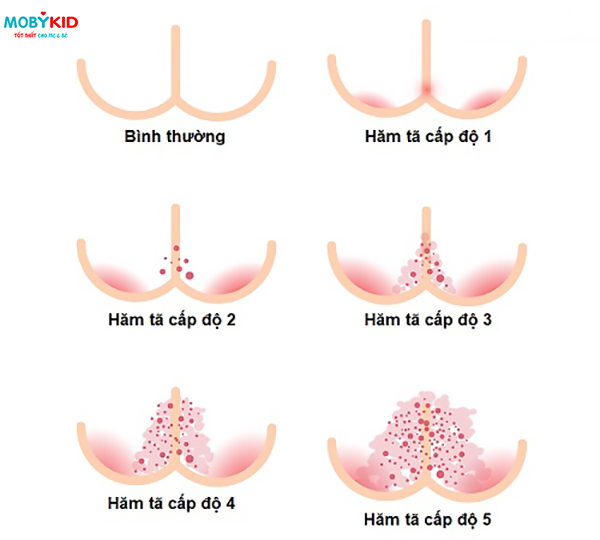 Hăm tã ở trẻ sơ sinh, cách phòng tránh và điều trị hăm tã