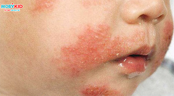 Sữa bột cho bé bị dị ứng đạm sữa bò và những lưu ý mẹ không nên bỏ qua