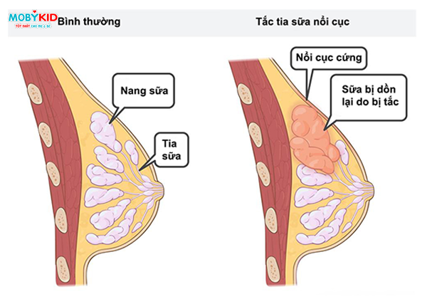 may-hut-sua-bang-dien-la-gi-nhung-loi-ich-quan-trong-cua-may-hut-sua-dien-10